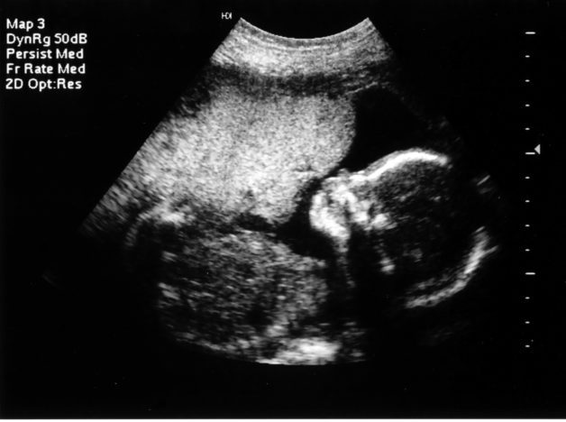 A sonogram photo.